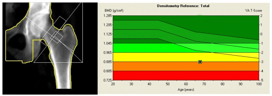 Marie's hip DEXA scan before: T-score −2.5, osteoporosis range